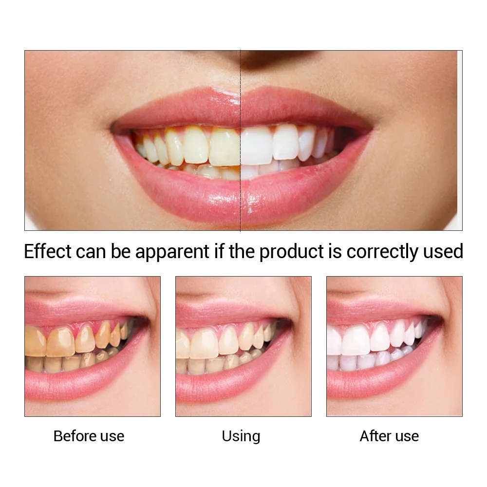 FTEENPLY Sbiancamento Dei Dent - Teeth Whitening Levels recensione e prezzo